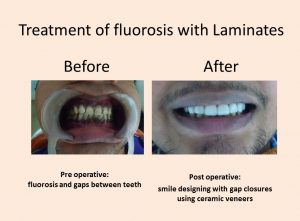fluorosis treatment dental laminates clinic delhi multispeciality